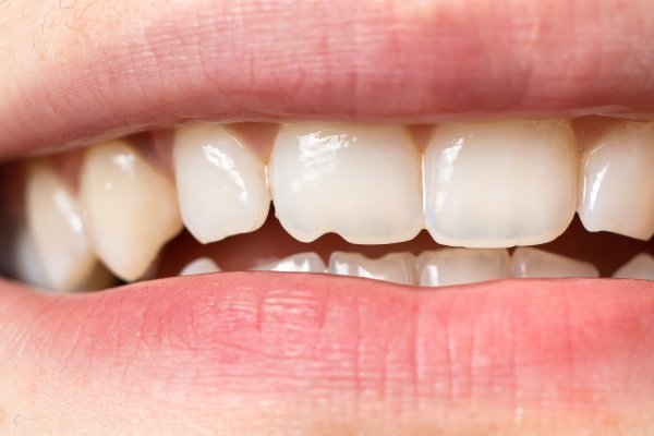 Macro close-up of human teeth. Shows the chipped tooth. The effect of the cutter's tooth from biting the seeds shell and solid food. For dentists, dental clinics - aesthetic minor damage. man smiling in dentists chair