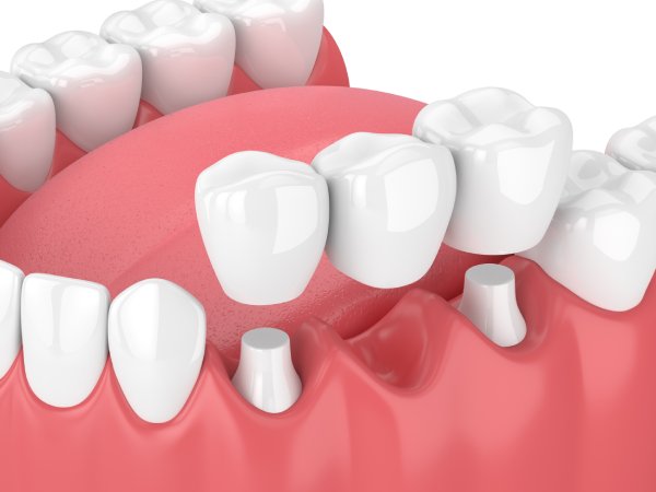 3d render of jaw with dental bridge man smiling in dentists chair