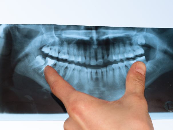 Dental X-Ray panoramic man smiling in dentists chair