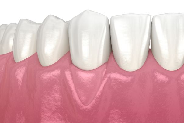 Gum Recession: Soft tissue graft surgery. 3D illustration of Dental treatment man smiling in dentists chair