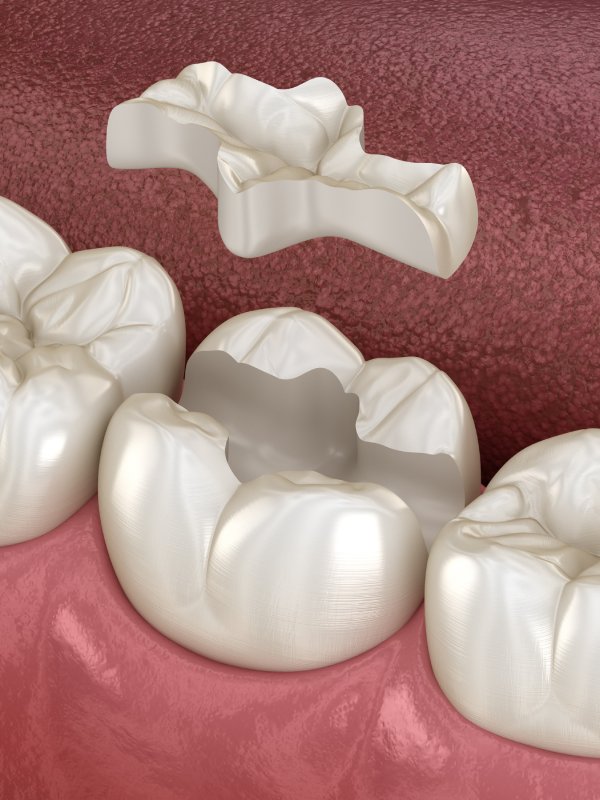 Inlay ceramic crown fixation over tooth. Medically accurate 3D illustration of human teeth treatment man smiling in dentists chair