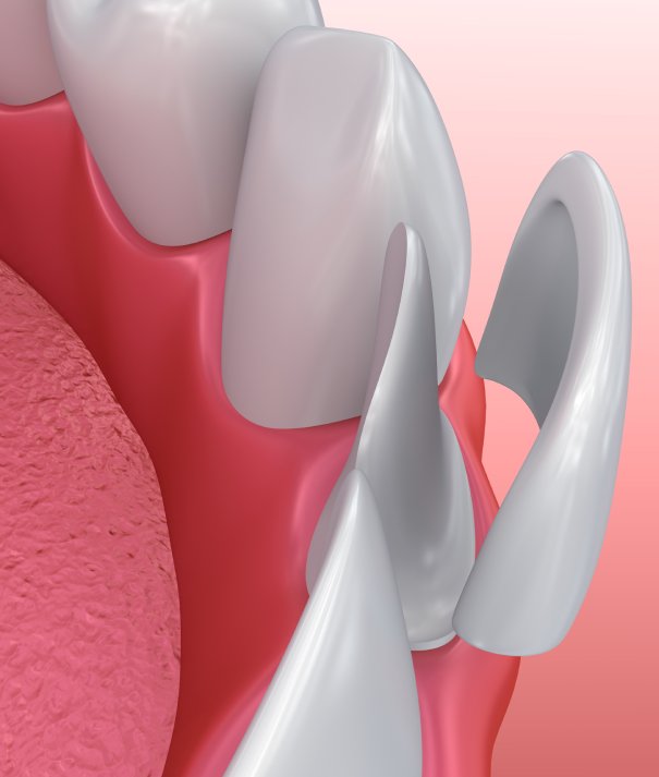 Dental Veneers: Porcelain Veneer installation Procedure. 3D illustration man smiling in dentists chair